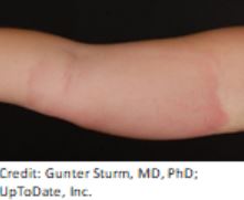 wasp sting infection signs