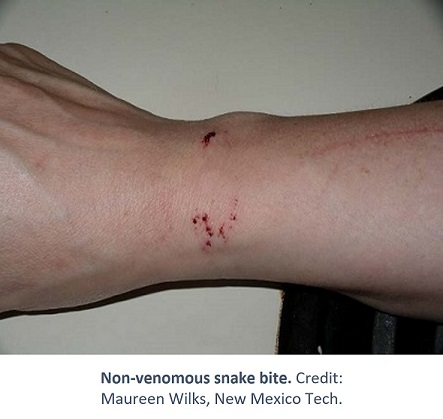poisonous snake bite wounds